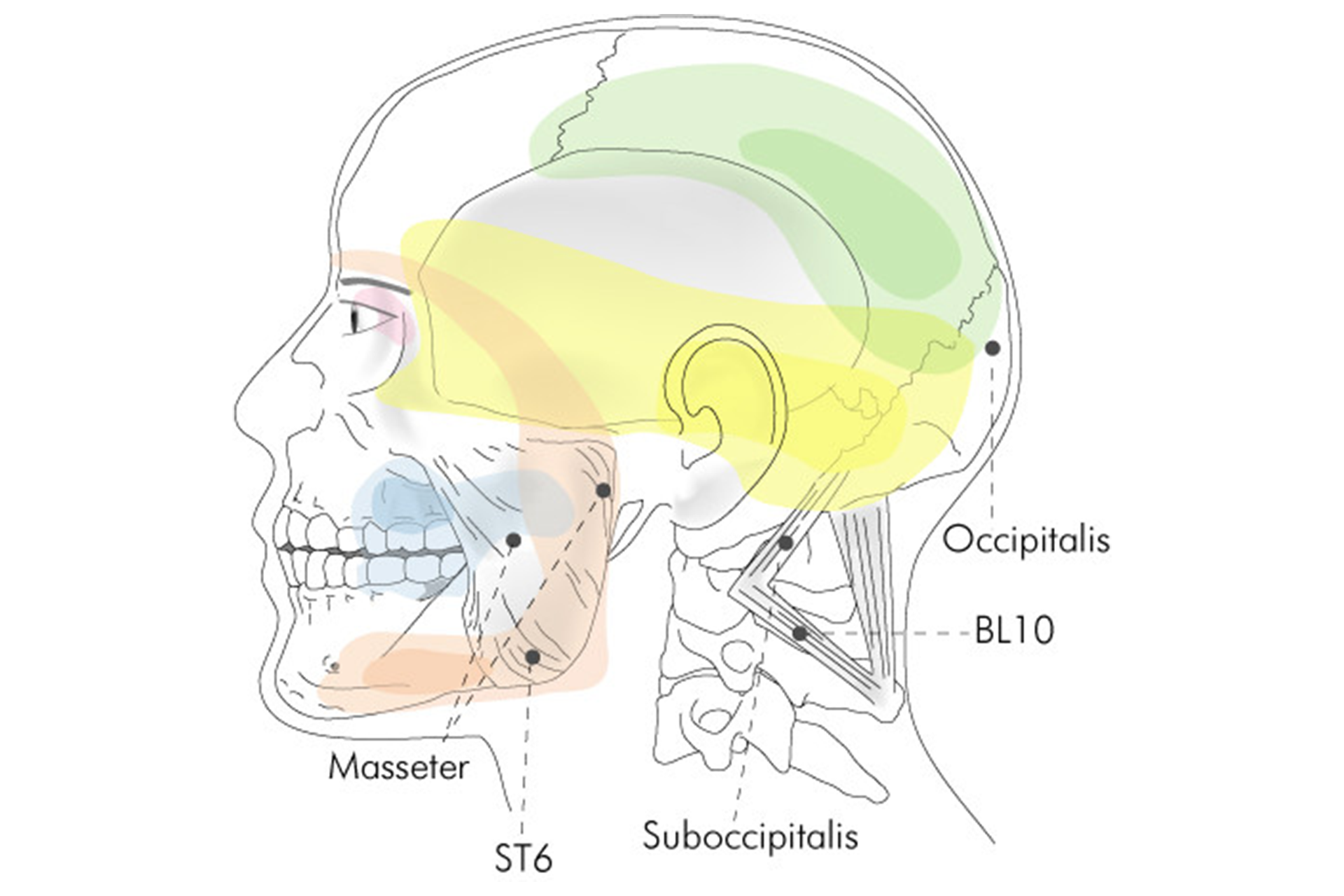 Trigger Point Injections Treat TMJ Disorder The Right Way